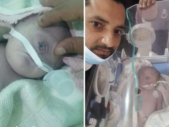 ولادة طفل بعين واحدة في اليمن