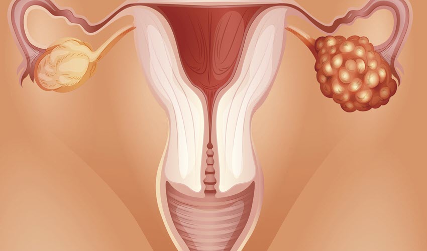 الأسئلة الشائعة حول تكيس المبايض وعلاقته بالكرش