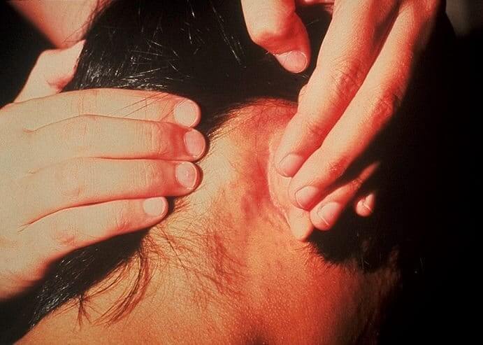 حبوب تظهر في منطقة الأذن