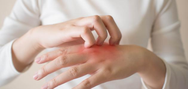 علاج ظهور نقط حمراء بدون حكة