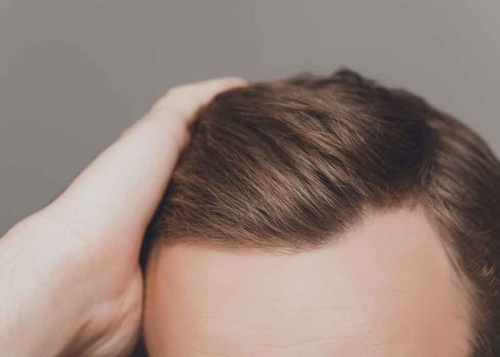 زراعة الشعر في الحلم