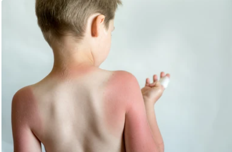 sunburn