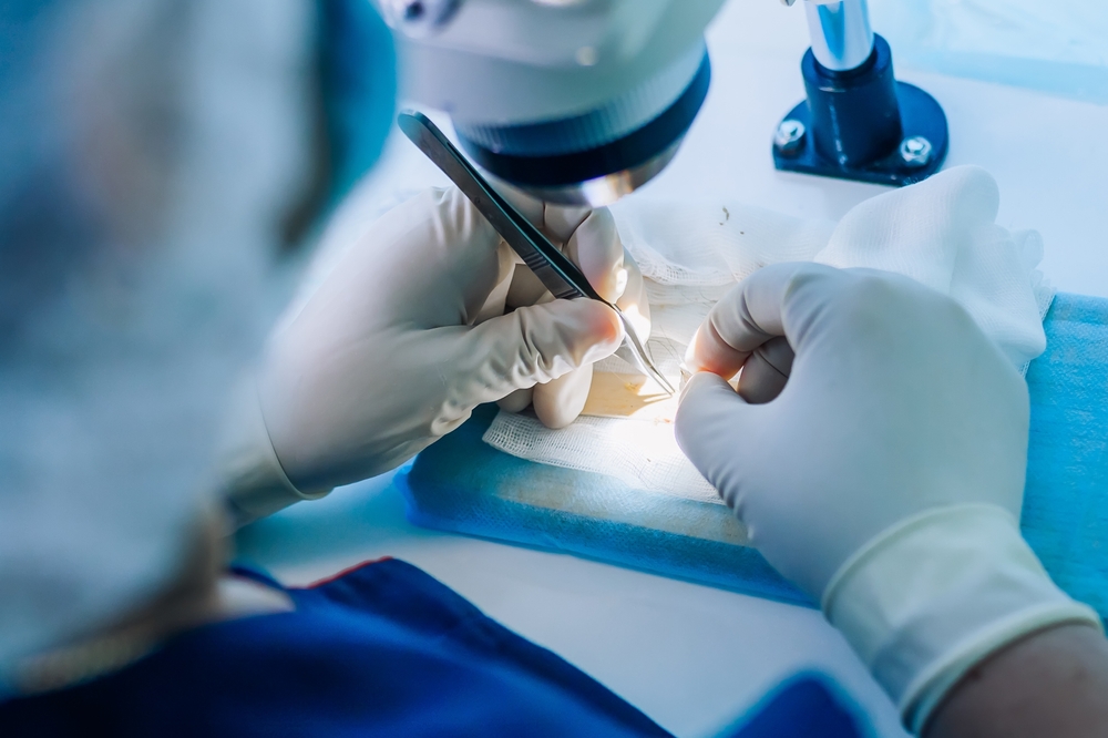 nerve transplant