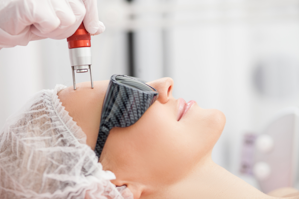 Laser skin resurfacing