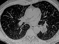 رئة الفشار: الأسباب، الأعراض، طرق العلاج