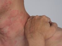 حساسية الارتكاريا (الشرى): الأسباب، الأعراض، طرق العلاج