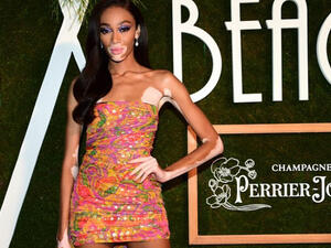 Winnie Harlow