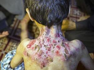  Iranian children who are suffering from EB (Twitter)