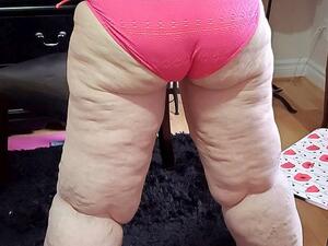 Katie Baker, 31, from Ontario, Canada, is trying to raise £112,000 for life- changing surgery to remove 20 litres of fat from her large legs (dailymail)