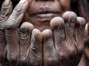 An older woman shows six fingers amputated to represent the loss of six loved ones. The tradition has not taken place since the 1990s  (DAILYMAIL)