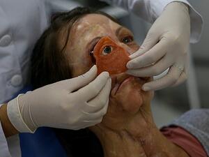 Denise Vicentin, 52, has had part of her face reconstructed using smartphones and 3D printers (AFP)