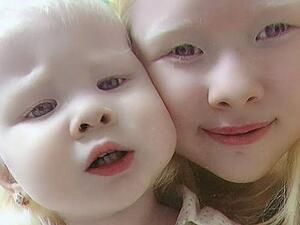 'The doctors were shocked, and thought that she was Russian,' recalls Aiman Sarkitova, their mother (dailymail)