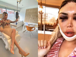 Brave Roddy wore a white bandage around her head as she sported heavily bruised and swollen eyes