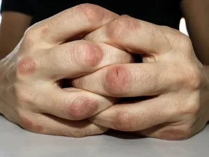 للتخلص من هذه العادة السيئة ينصح الخبير بتدليك العضلات