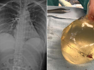 حشوة سيليكون