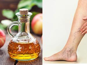 طبيب البوابة: 3 طرق طبيعية للتخلص من الأوردة العنكبوتية