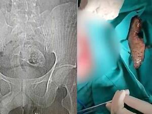 إزالة سمكة بلطي نافقة من بطن مريض