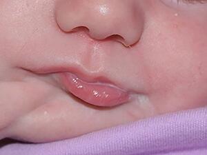 This South Carolina Baby Girl was Born With a Second Mouth (Twitter)