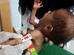A Yemeni child suffering from malnutrition is measured at a treatment centre in Yemen's northern Hajjah province on July, 5, 2020. The war in Yemen, the Arabian peninsula's poorest country, has mutated into what the United Nations calls the world's worst humanitarian crisis. (AFP)