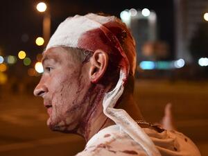 An injured man is seen during clashes between riot police and opposition supporters in Minsk on August 10, 2020. A man died during rallies in Belarus on August 10 night when an explosive device went off in his hand, police said, confirming the first casualty of post-election protests. Sergei GAPON / AFP