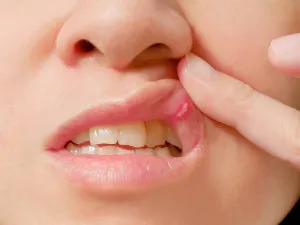  يمكن مواجهة بثور الفم بواسطة مزيج الكركم وعسل النحل