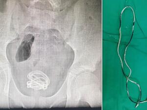 سلك كهربائي بطول 60 سم يستقر في مثانة طفل صيني