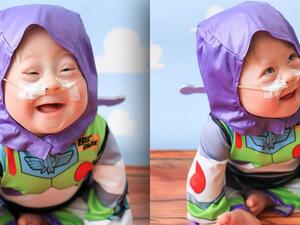 متلازمو داون