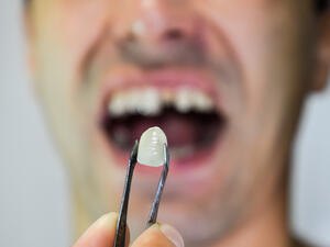 Man files a lawsuit after he slipped and broke his teeth