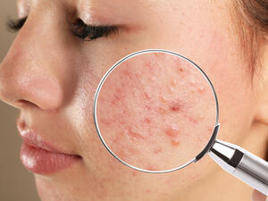 A teen with acne problems