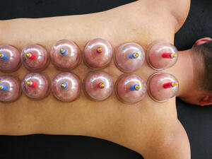 Multiple vacuum cup of medical cupping therapy on human body