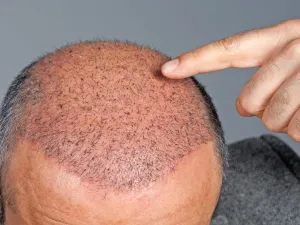 زراعة الشعر في الحلم