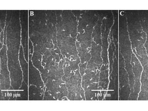 WCM-Q Researchers Use Pioneering Eye Exam To Identify Nerve Damage In Long Covid Patients