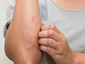 7 أطعمة يجب تجنبها عند الأطفال المصابين بالأكزيما