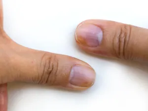 زراق الأطراف..الأسباب والعلاج