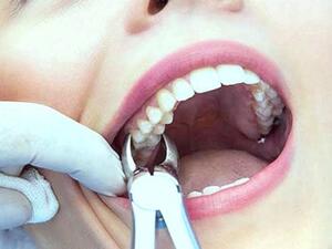 محاكمة طبيب أسنان ووالده بتهمة اقتلاع 580 سنا سليمة