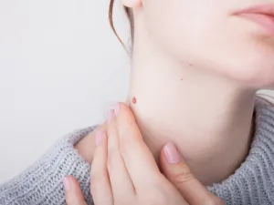 علاج الثالول من الصيدلية