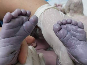 ولادة طفلة عراقية بــ 24 إصبعًا