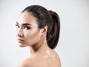 كريم أوبزيلورا Opzelura أول علاج مرخص للبهاق