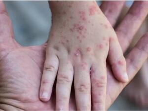 فيروس جدري القردة