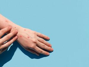 monkeypox cases