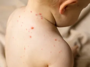 مرض الجدري: أعراضه، مضاعفاته، طرق علاجه