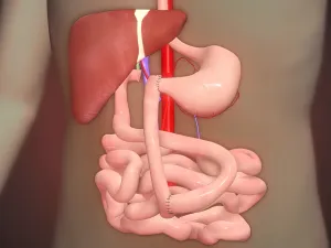 شلل الأمعاء: الأعراض، الأسباب، المضاعفات، العلاج