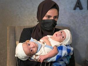 التوأم السيامي العراقي "علي وعمر"