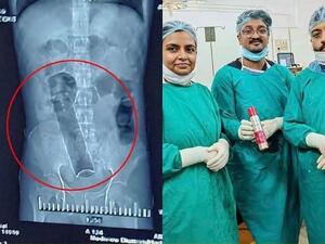 مزيل عرق في أمعاء مريض في الهند