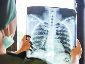 Tuberculosis deaths rising again in Europe