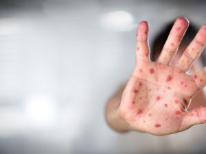 Jordan records 27 measles cases