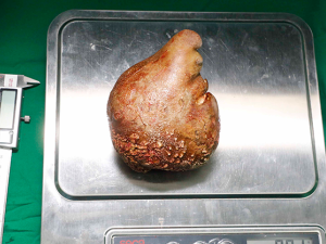 أكبر حصوة في العالم