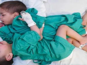 فصل التوأم السيامي السوري "إحسان وبسام" 