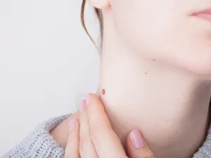 طبيب البوابة: طرق علاج التقرن الدهني (Seborrheic keratosis) 