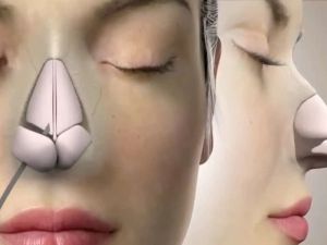 افضل دكاترة تجميل الانف في الرياض